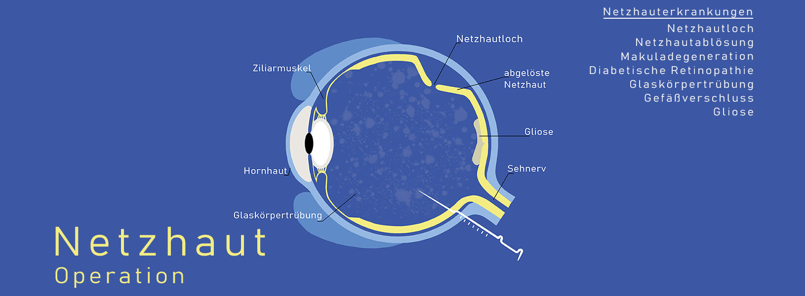 Infografik zum Thema Netzhaut mit einer stilisierten Darstellung eines Auges