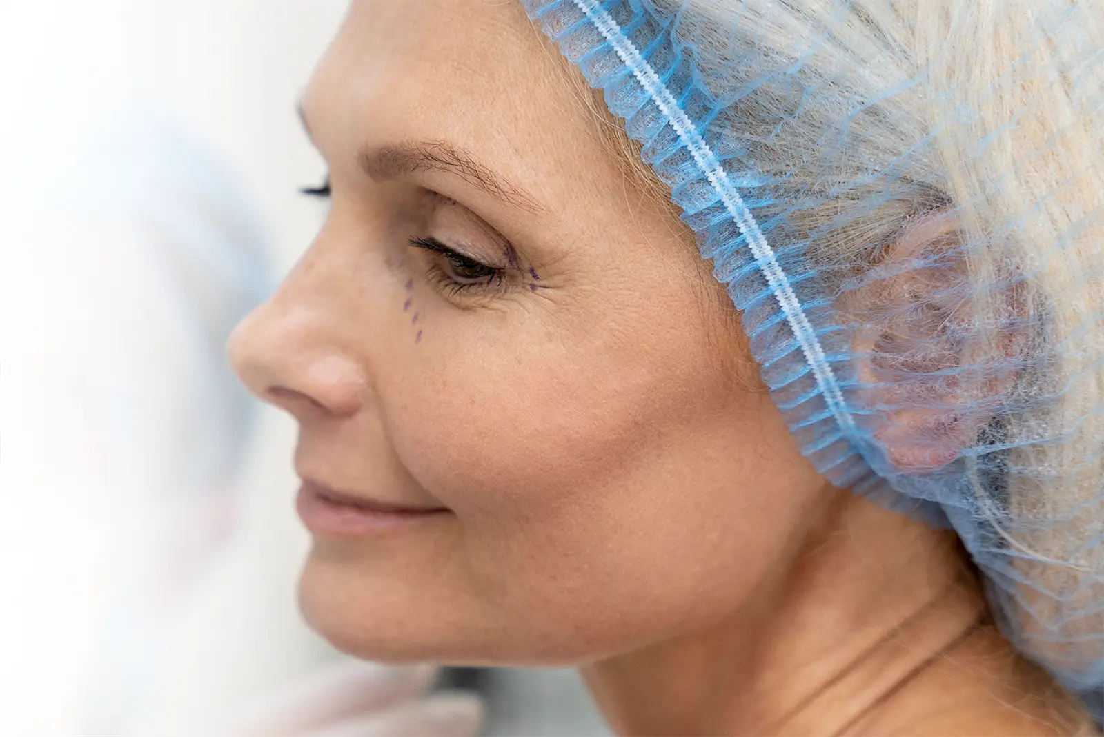 Foto einer Frau, die für einen operativen Eingriff zur Augenlidkorrektur vorbereitet wird