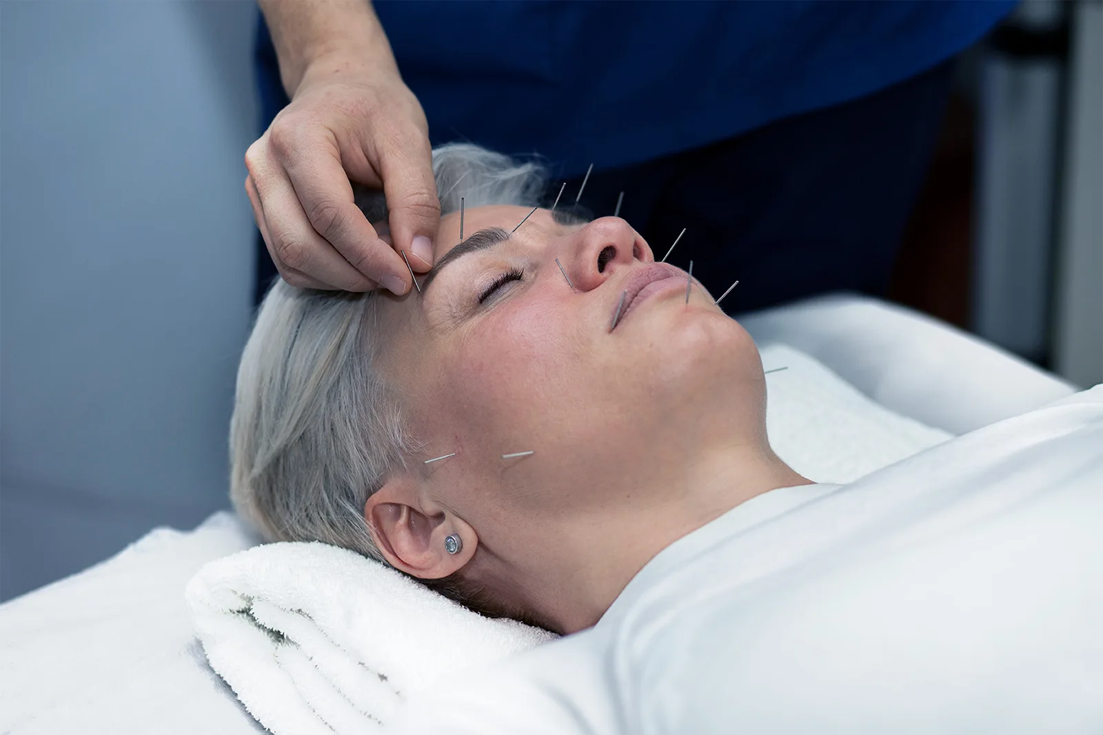 Akupunkturbehandlung im Gesicht einer jungen Frau