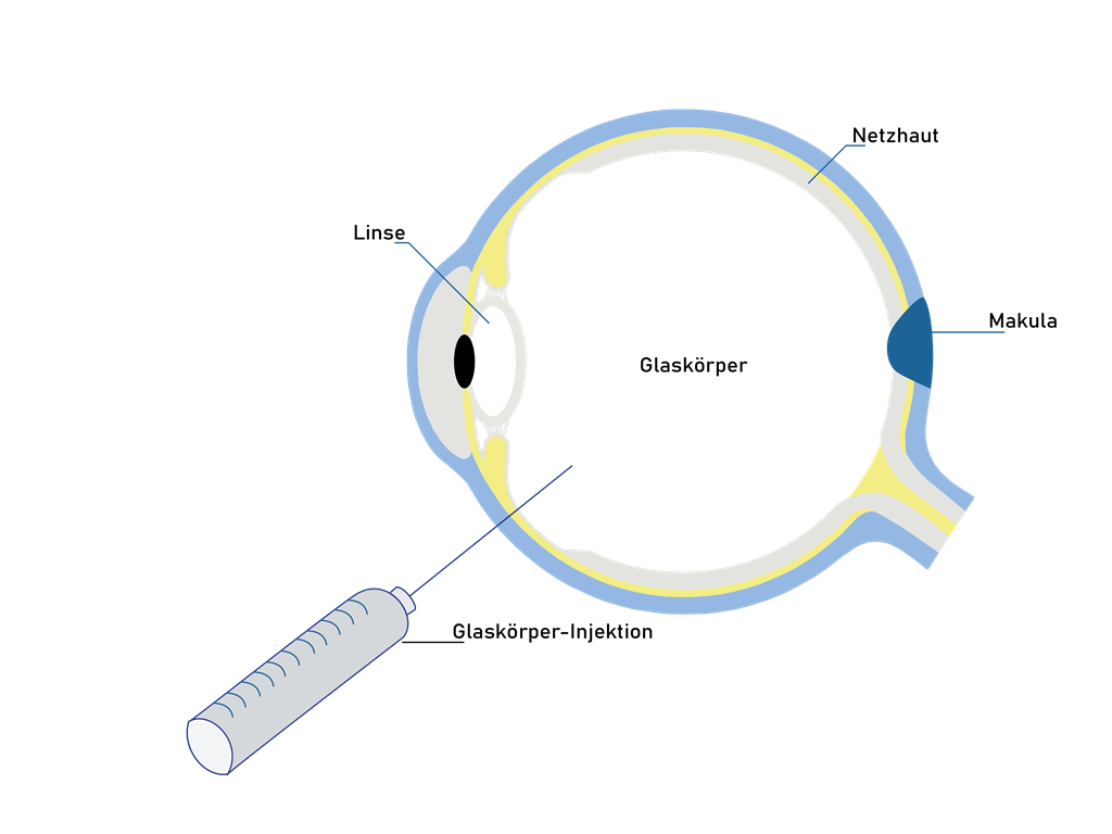 Infografik über den Aufbau des Auges und die Operation der Glaskörperinjektionen